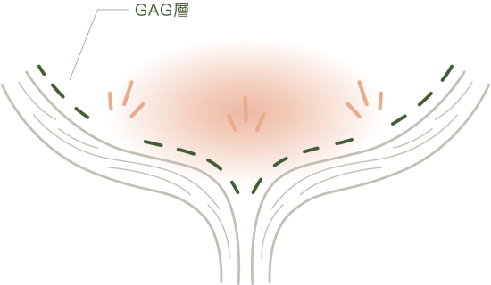官網_Broadreach優抗官網介紹頁_1205_02_膀胱炎